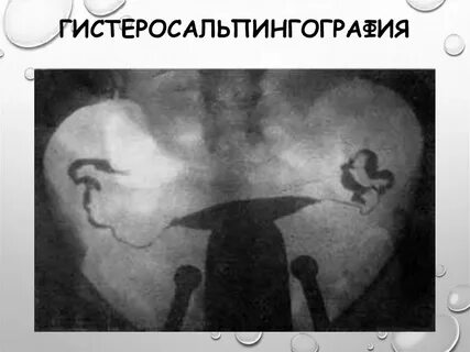 Больные маточные трубы