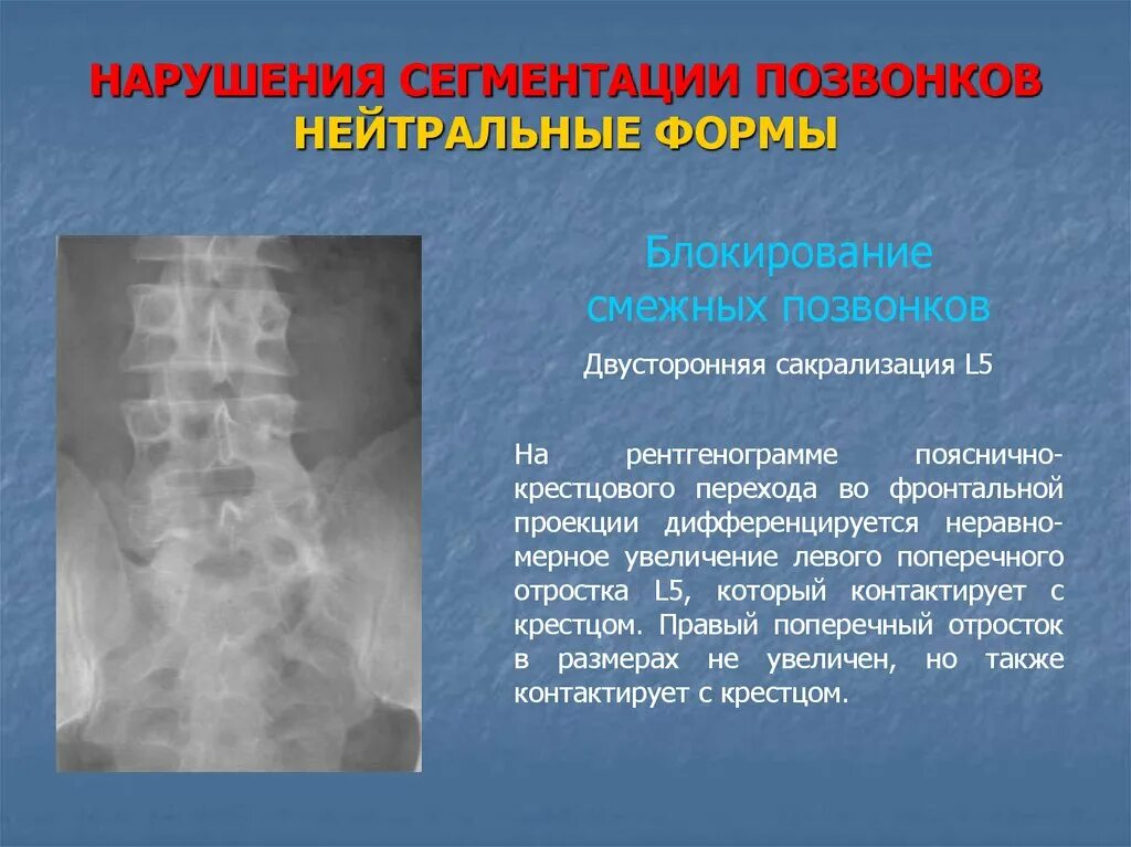 Аномалии развития позвоночника. Аномалии развития поясничных позвонков рентген. Аномалии развития тел позвонков крестцовых. Конкресценция шейных позвонков с5-с6 рентген. Люмбализация s1.