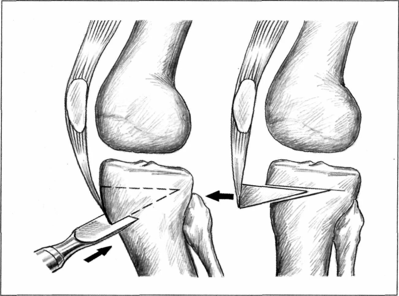 Латерализация надколенника. Контрактура мышц коленного сустава. Операция остеотомия коленного сустава. Сгибательная контрактура коленного сустава. Остеотомия локтевого сустава.