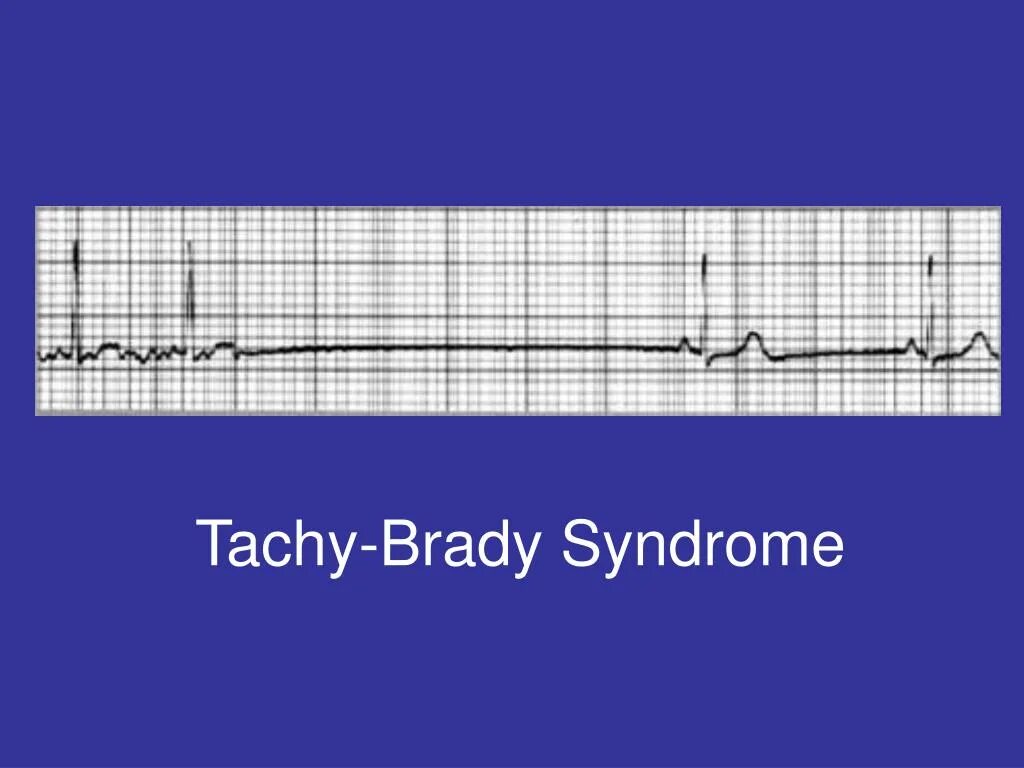 Брадикардия можно ли заниматься спортом. Синдром брадикардии-тахикардии на ЭКГ. Синдром бради тахикардии. Синдром бради-тахикардии на ЭКГ. СССУ Тахи-бради синусовая тахикардия.