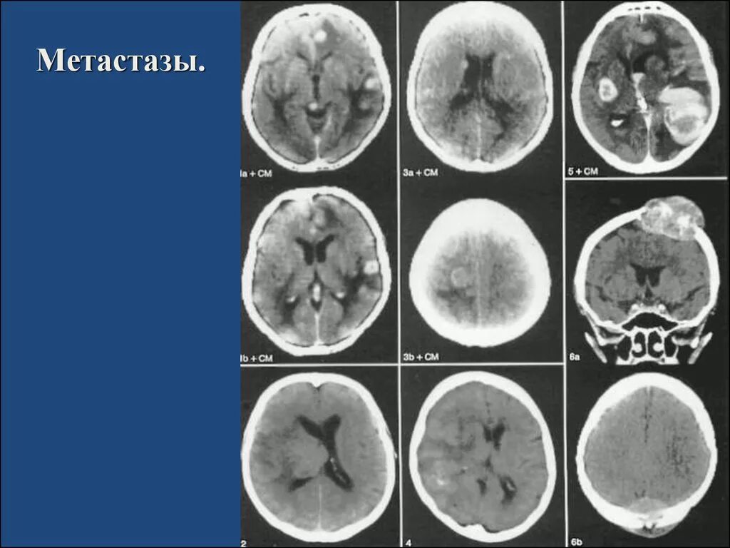 Метастазы в мозг прогноз. Метастазы головного мозга кт. Метастазы головного мозга кт кт. Метастатические опухоли головного мозга.