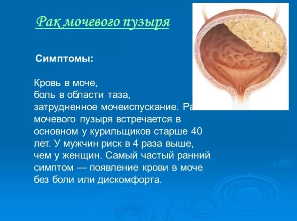 Застудил мочевой пузырь у мужчин. Заболевания мочевого пузыря. Болезни мочевого пузыря у женщин. Опухолевые заболевания мочевого пузыря. Мочевой пузырь болезни симптомы.