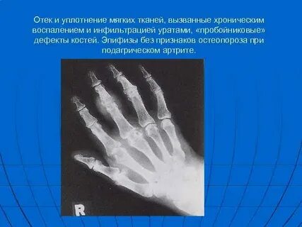 Отек параартикулярных мягких