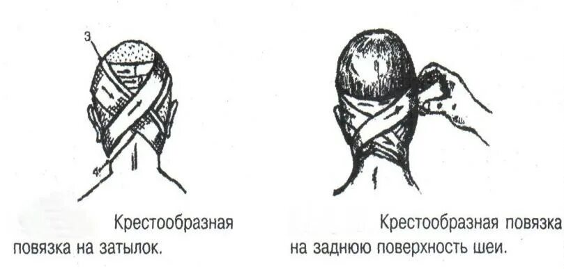 Повязка манипуляция. Техника наложения крестообразной повязки на затылок. Крестообразная повязка техника наложения. Крестообразная повязка на затылок алгоритм. Крестообразная повязка на заднюю поверхность шеи алгоритм.