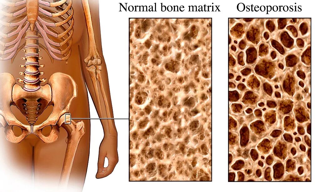 Остеопороз патологическая анатомия. Остеопороз кость. Люди с остеопорозом.