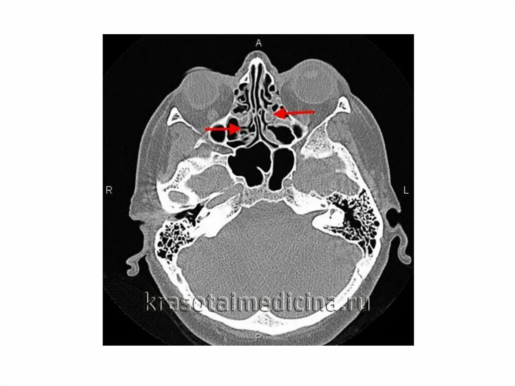 Хронический сфеноидит. Компьютерная томография этмоидит. Сфеноидит на кт. Хронический этмоидит на кт.