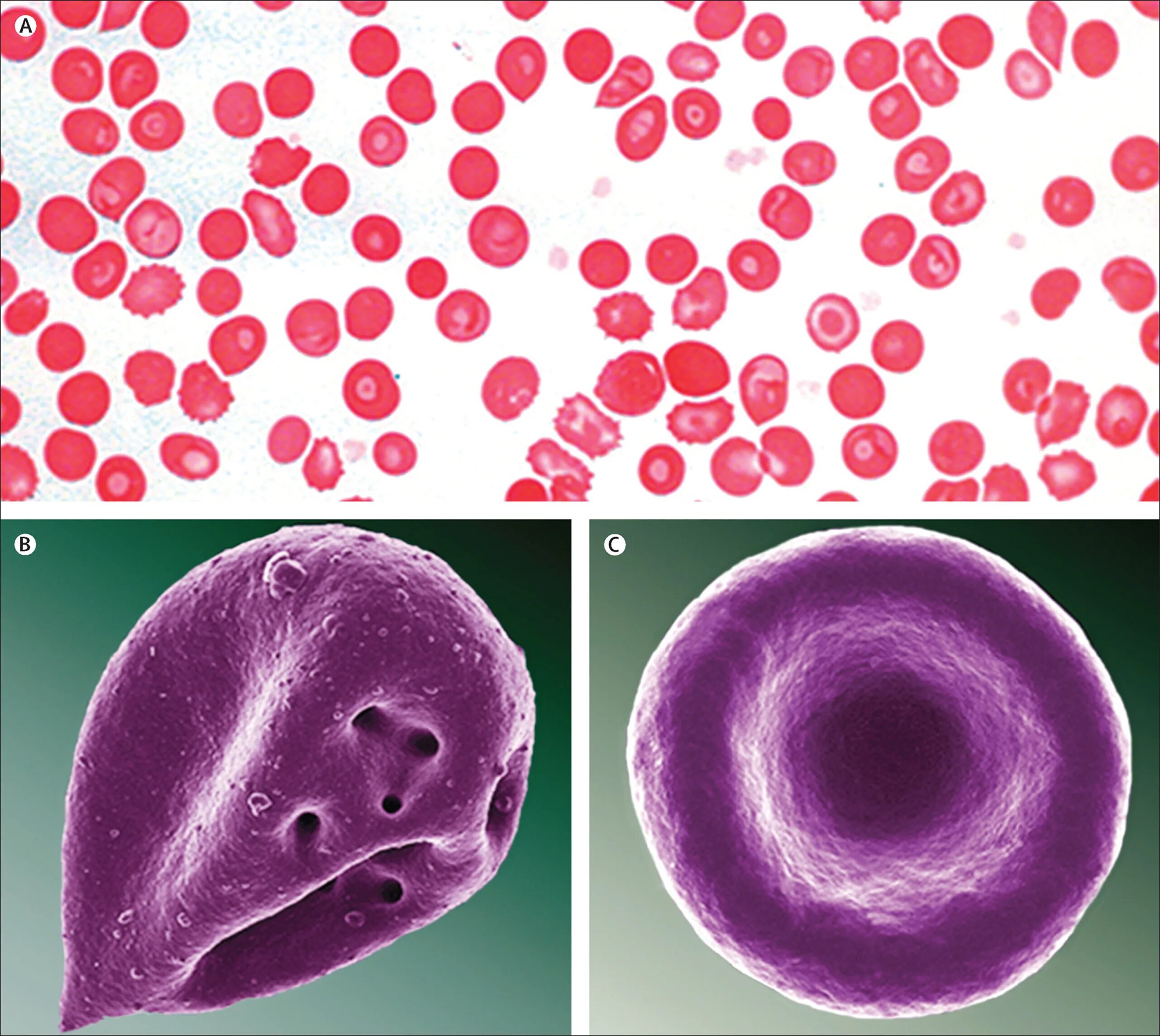 Цитоплазма эритроцитов человека. Эритроциты. Деформация эритроцитов. Клетки крови эритроциты. Эритроцит деформация эритроцитов.