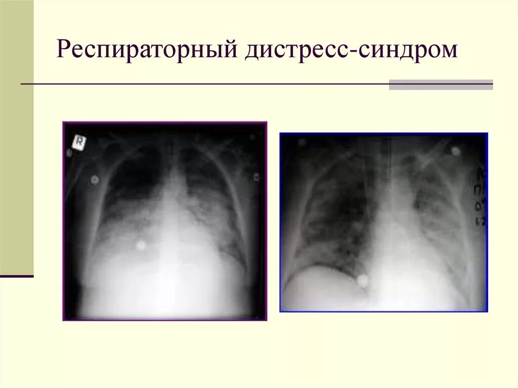 Респираторный дистресс синдром взрослых. Респираторный дистресс синдром на рентгенограммах. Острый респираторный дистресс синдром рентгенограмма. Респираторный дистресс-синдром (РДС. Респираторный дистресс-синдром взрослых рентген.