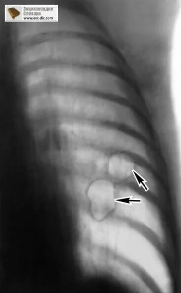 Буллезная эмфизема легкого рентген. Кардиодиафрагмальная липома. Буллезная эмфизема рентген пневмоторакс. Удаление булл в легких. Удаление булл в легких.