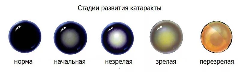 Начальная старческая катаракта. Классификация катаракты по локализации. Катаракта перезрелая стадия. Старческая катаракта классификация. Стадии развития возрастной катаракты.