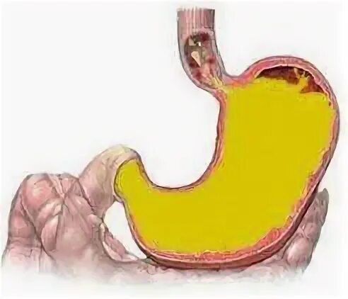 Желчи в желудок заброс желчи. Желчная кислота в желудке. Заброс из желчного пузыря в желудок.