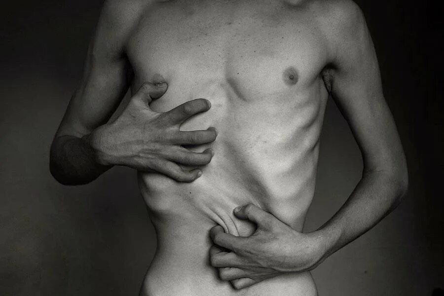 Юлия поджарая. Худой больной человек. Порша де росси анорексия. Кахектическая анорексия. Анорексия нина гамильтон.