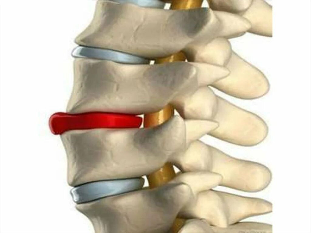 Дисков поясницы. Протрузия межпозвонковых дисков. Экструзия диска l5-s1 что это такое. Протрузия дисков позвоночника что это такое. Протрузия грыжа межпозвонковых дисков.