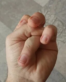Сводят пальцы рук лечение