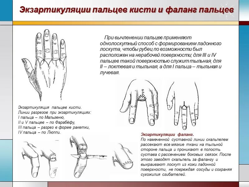 Техника ампутации и экзартикуляции фаланг пальцев. Экзартикуляция фаланг пальцев кисти. Ампутация пальца карта вызова СМП. Ампутация 1 пальца кисти техника.