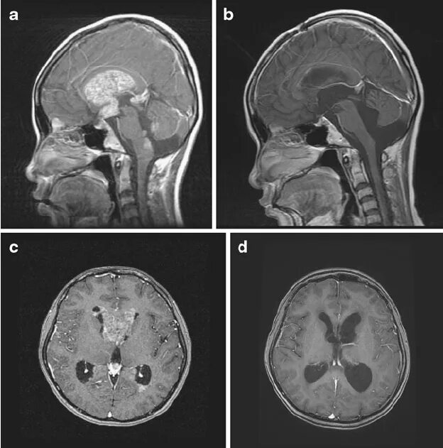 Герминома. Перивентрикулярный лейкоареоз на кт. Перивентрикулярная лейкомаляция кт.