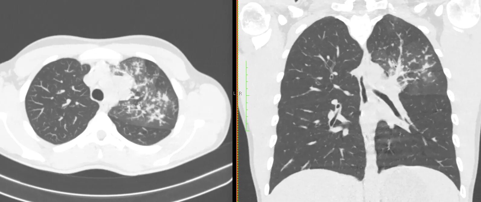 Бронхиолит на кт легких. Дерева в почках в легких кт. Симптом дерево в почках в легких на кт. Фолликулярный бронхиолит. Дерева в почках в легких кт.