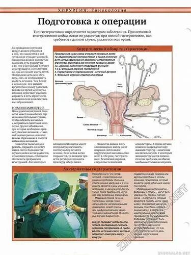 Лапароскопия и гистероскопия. Лапароскопия миомы матки. Лапароскопия и гистероскопия. Удаление матки форум отзывы последствия. Лапароскопия экстирпация матки.