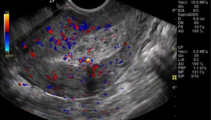 Эндометриома матки УЗИ. Лохиометра это