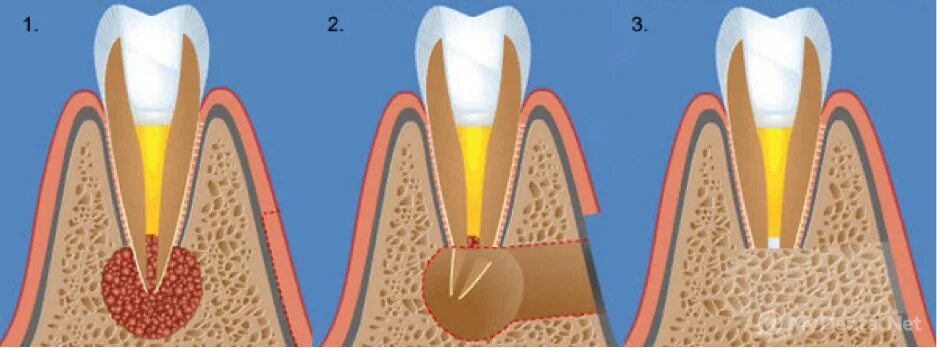 Киста зуба под микроскопом Pin on tooth