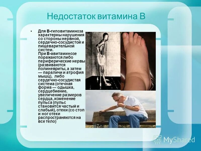 при недостатке витамина в1 развивается. заболевания при недостатке витамина а. атрофия мышц недостаток какого витамина. атрофия мышц недостаток какого витамина. недостаток витамина b1.