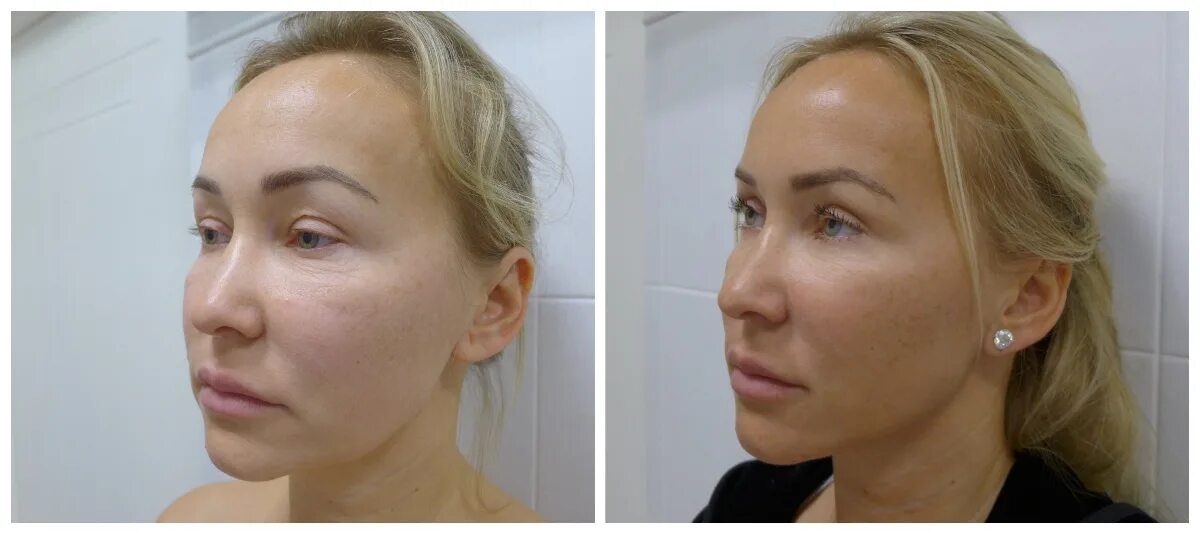 Эндоскопическая височная подтяжка