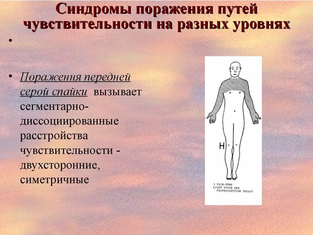 Типы поражения чувствительности. Синдромы поражения чувствительности. Нарушения чувствительности на различных уровнях. Синдромы нарушения чувствительности. Чувствительный синдром.