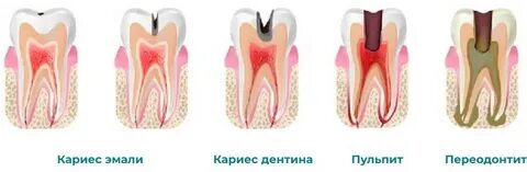 Периодонтит зуба что