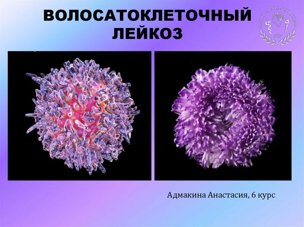 Волосатоклеточный лейкоз стадии. Волосатоклеточный лейкоз хлл. Волосатоклеточный лейкоз клинические рекомендации. Лейкемия клинические рекомендации. Волосатоклеточный лейкоз по утвержденным клиническим рекомендациям.
