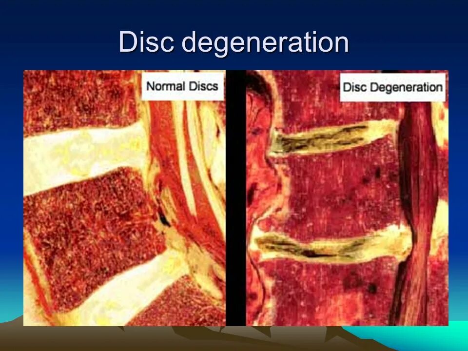 Жировая дегенерация костного мозга по типу Modic 2. Жировая дегенерация костного мозга. Жировая дегенерация позвонков. Жировая перестройка тел позвонков.