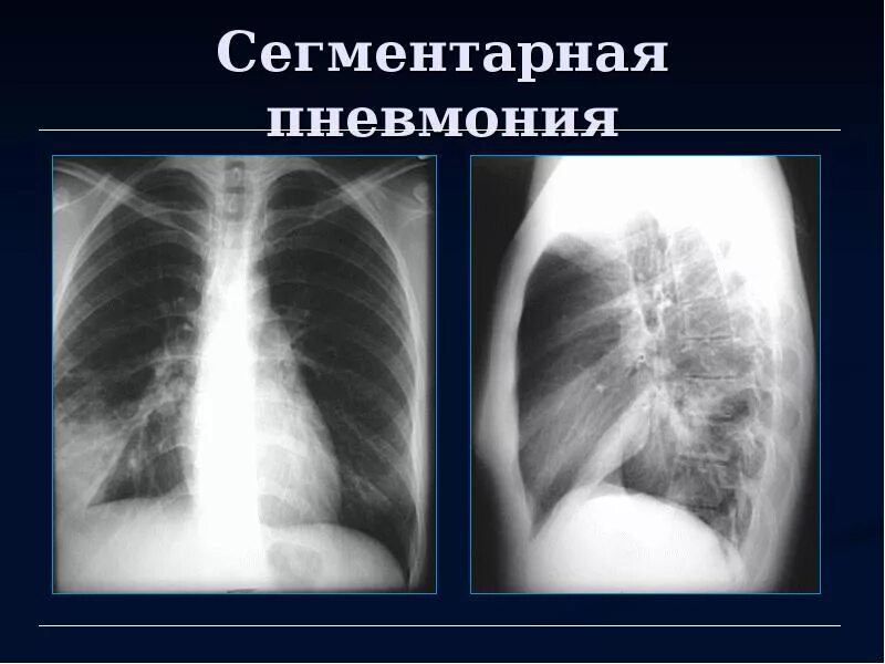 Пневмония 9 сегмента. Пневмония правосторонняя s4 s5. сегментарная пневмония на ренгтен. очаговая пневмония рентген. правосторонняя сегментарная пневмония рентген.