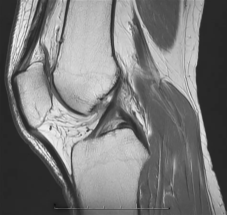Joint mri. Фрагментация акромиона. Разрыв мениска коленного сустава на мрт. Разрыв мениска коленного сустава на мрт. Joint mri.