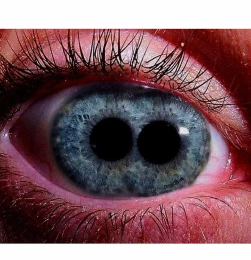 Жизнь с одним глазом. PUPULA Duplex двойной зрачок. Поликория аномалия глаз.