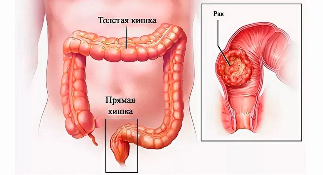 Толстый кишечник опухоль. Опухоль Толстого кишечника. Новообразования в прямой кишке.