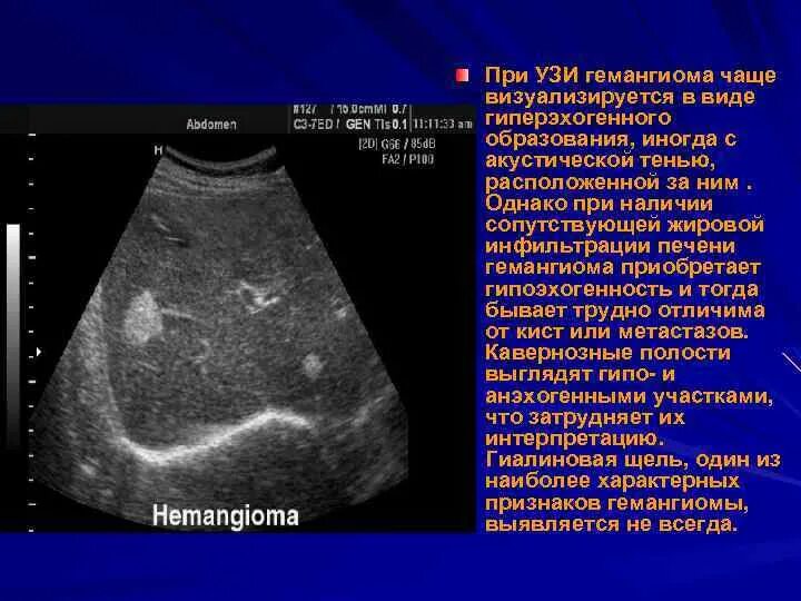 Округлое образование печени. Кавернозная гемангиома печени на УЗИ. УЗИ картина кавернозной гемангиомы печени. Гемангиомы печени при УЗИ характеризуются. Гемангиома печени на УЗИ описание.