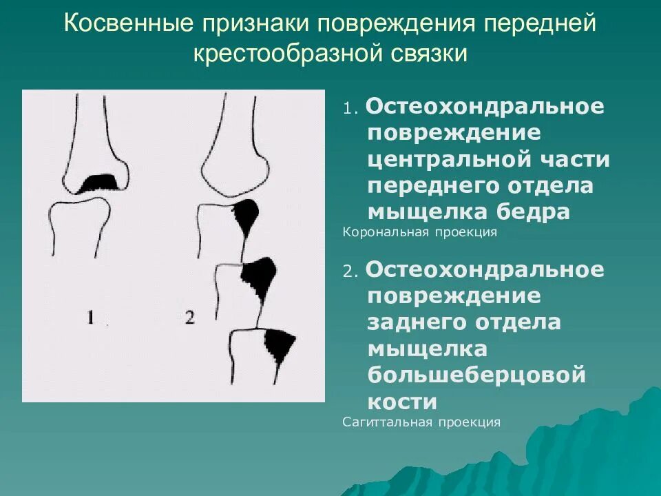 Повреждение мыщелка. Остеохондральное повреждение мыщелка. Остеохондральное повреждение большеберцовой кости. Остеохондральное повреждение надколенника. Остеохондральный перелом латерального мыщелка бедренной кости.