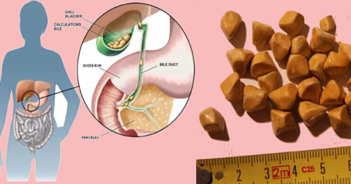 Ли растворить камни в желчном пузыре. Желчный пузырь с камнями анатомия. Желчекаменная болезнь камни. Холестериновые камни в желчном пузыре. Конкременты желчного пузыря что это такое.