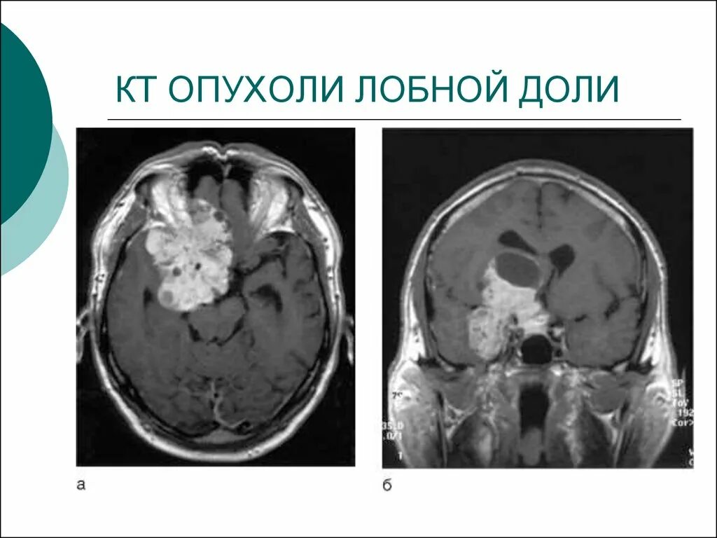 Опухоли лобной части. Глиома головного мозга кт. Опухоль лобно-височной доли кт. Глиобластома теменной доли головного мозга. Глиобластома головного мозга на кт.