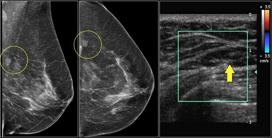 Интрамаммарный лимфатический узел УЗИ. Интрамаммарный лимфоузел на маммографии. Подмышечные лимфоузлы на маммографии. Интрамаммарный лимфоузел молочной железы на УЗИ.