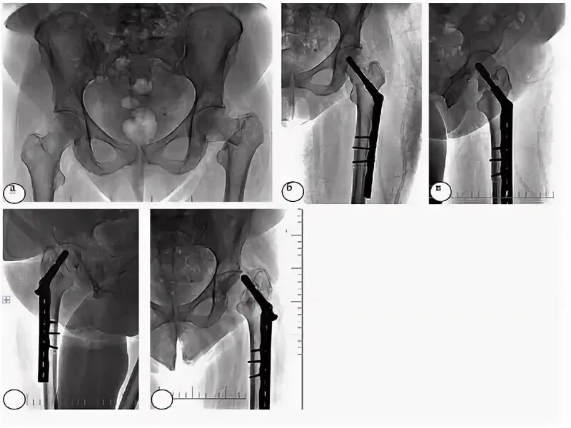Остеосинтез шейки левой бедренной кости. Шейка бедра перелом остеосинтез. Остеосинтез шейки бедра системой Targon.