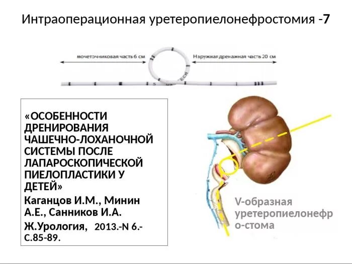 Мочеточникового сегмента