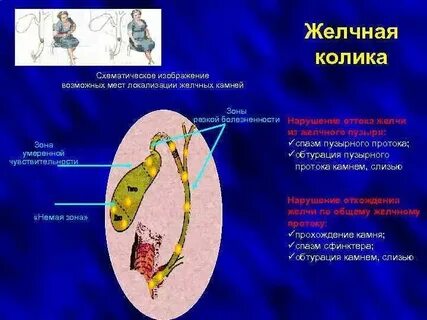 Приступ после удаления желчного пузыря