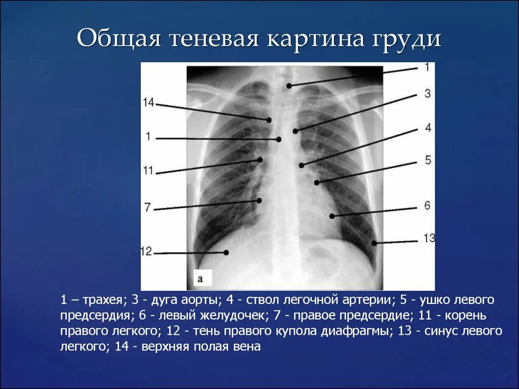 Средостение рентген анатомия. Дуги средостения рентген. Дуга аорты анатомия рентген. Грудная клетка рентген анатомия. Что значит легкие расширены