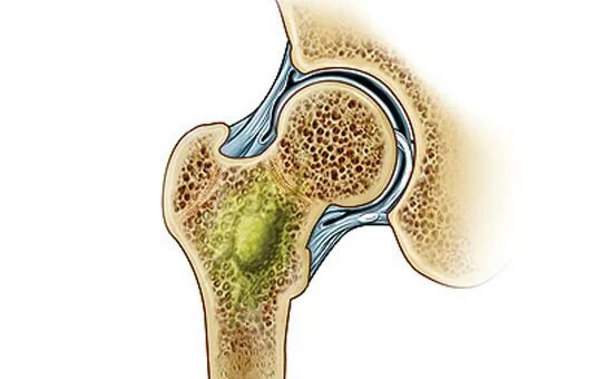 Ревматоидный артрит суставы. Ревматоидный артрит rjktyjh. Строение кости надкостница кость. Костный мозг суставы. Костный мозг суставы.