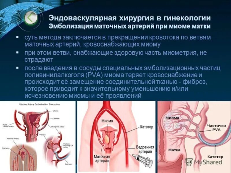 Эмболизация маточных артерий при миоме матки. Эндоваскулярная эмболизация маточных артерий. эмболизация маточных вен. эмболизация артерий методика. эмболизация сосудов матки.