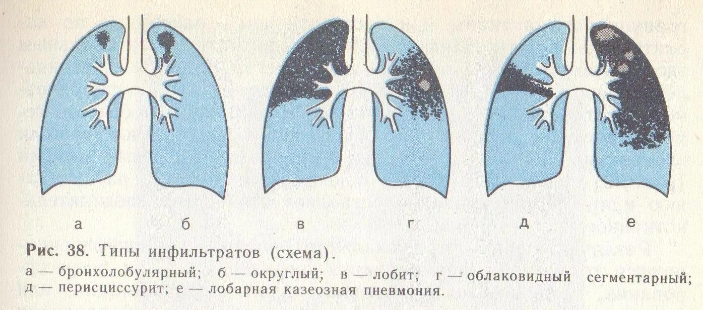 Что значит сегментарная пневмония
