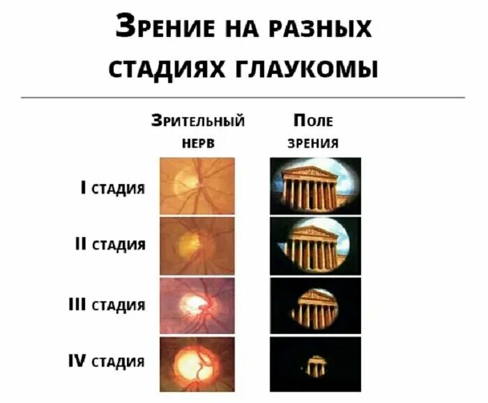 Можно вернуть зрение при глаукоме. Поле зрения при глаукоме 3 степени. Поля зрения при глаукоме 2 степени. Этапы развития глаукомы. Глаукома стадии и степени.