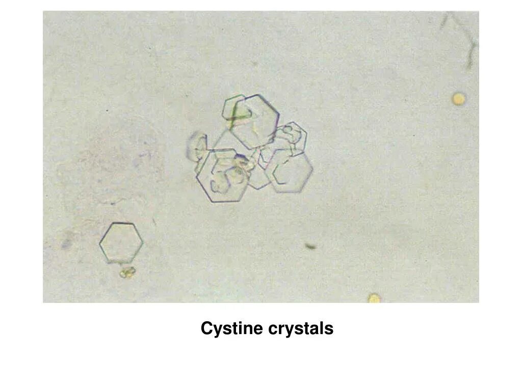 Повышен цистин в моче. Кристаллы цистина в моче микроскопия. Цистин в моче микроскопия. Цистин микроскопия. Кристаллы цистеина в моче.