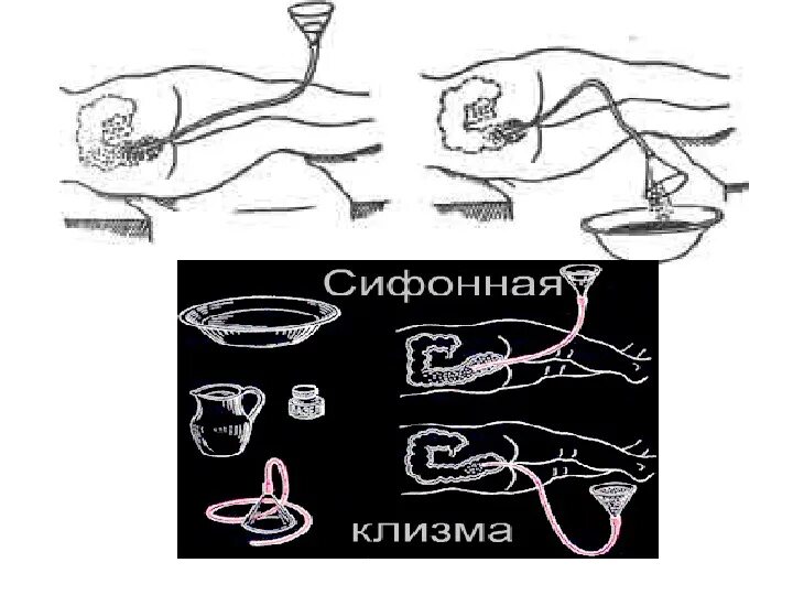 Сифонная клизма кратность. Техника постановки сифонной клизмы алгоритм. постановка сифонной клизмы. сифонная клизма глубина введения наконечника. глубина введения сифонной клизмы.
