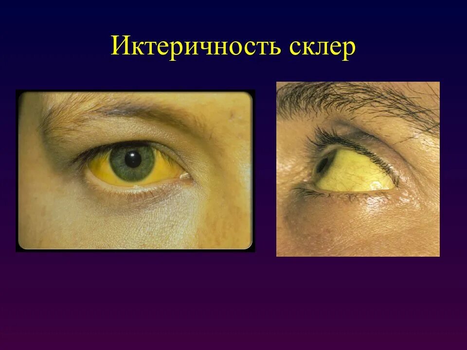 Симптомы гепатита желтухи. Субиктеричность склер. Желтушность склер глаз. Желтушность склер при гепатите.